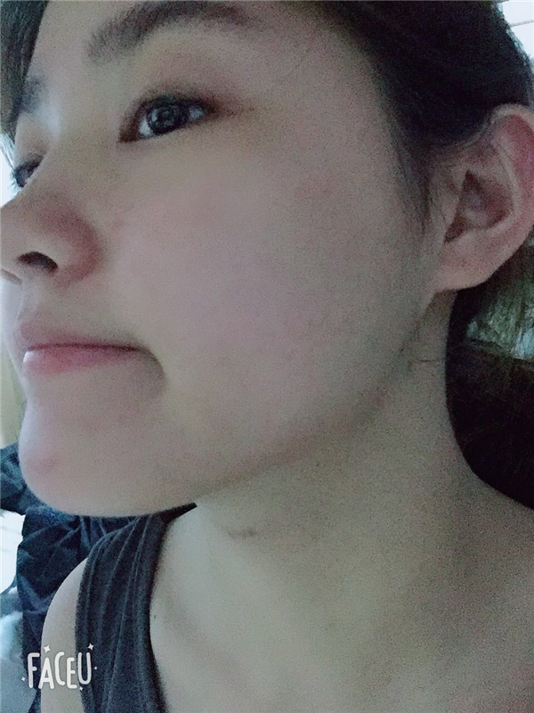 广州瑞港熊炜吸脂怎么样?价格案例