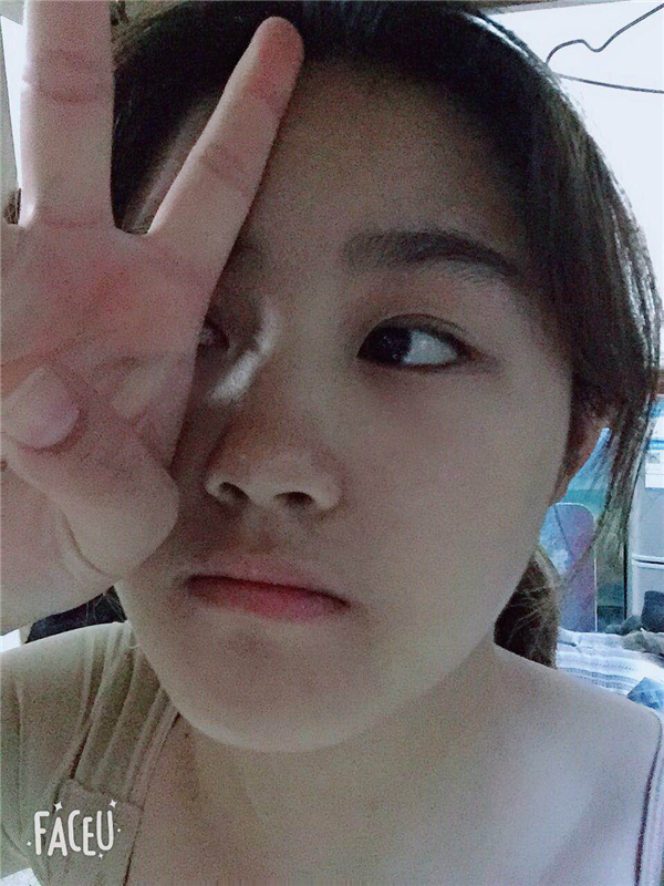 广州瑞港熊炜吸脂怎么样?价格案例