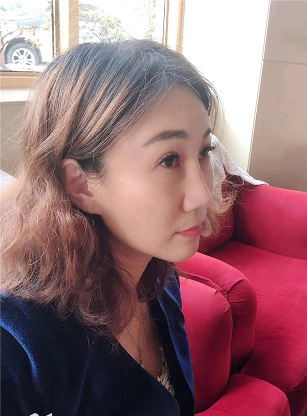 青岛伊美尔杨文国鼻部手术怎么样?价格案例