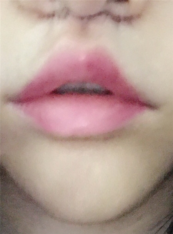 杭州丽本周洁丰唇怎么样?价格案例