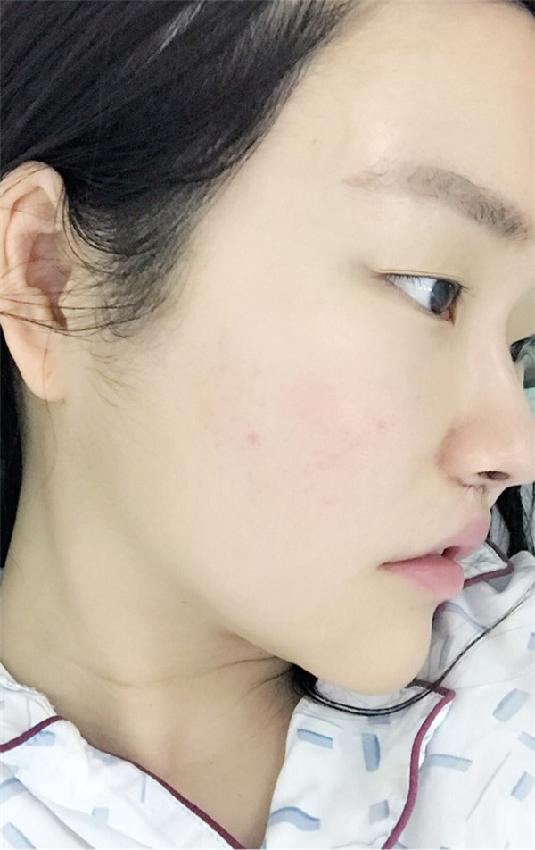 杭州丽本周洁丰唇怎么样?价格案例