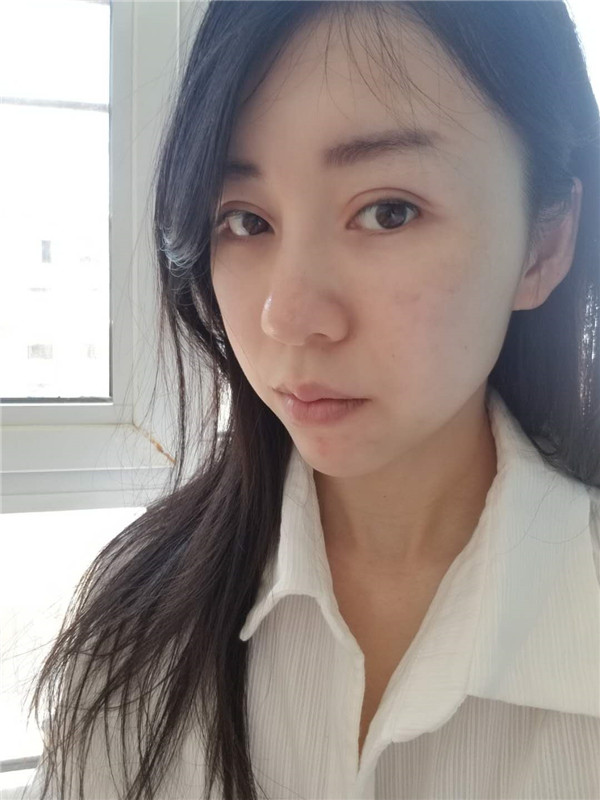 广州健丽王科学激光去眼袋怎么样?价格案例