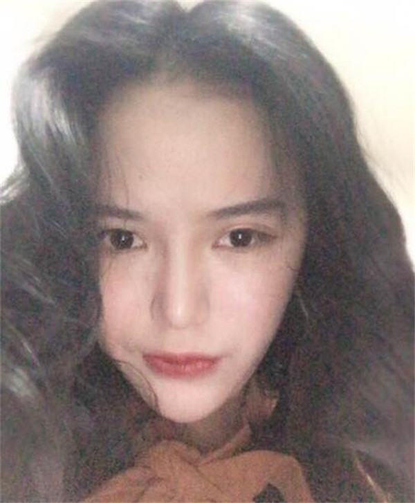 南京红颜会王凯军双眼皮怎么样?价格案例