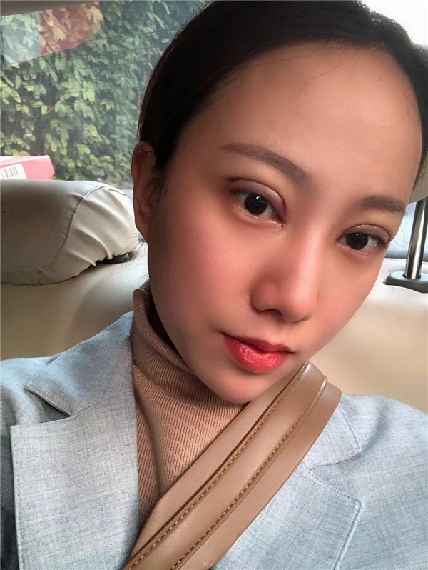 南京华韩奇致刘大猛眼部整形怎么样?价格案例
