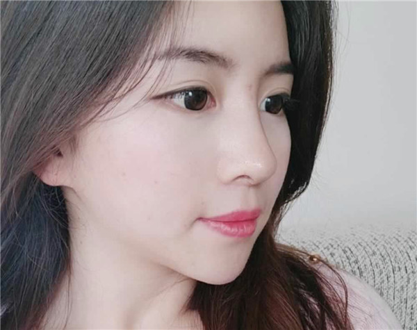 佛山医博士刘哲隆鼻怎么样?价格案例