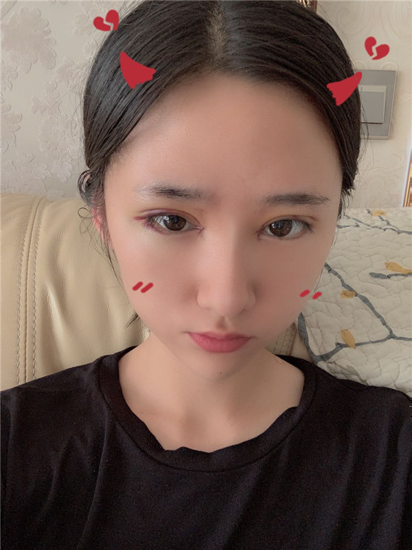 家庄雅芳亚丁庆丰双眼皮怎么样?价格案例