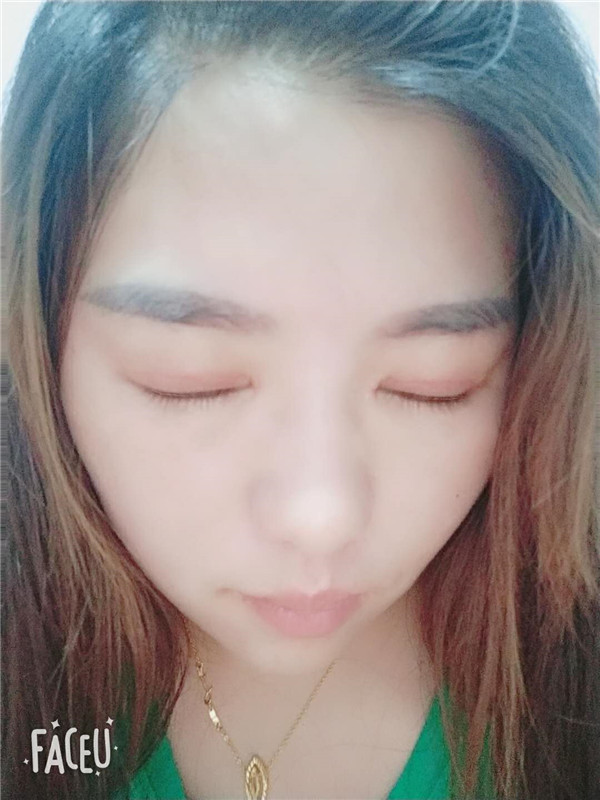 北京圣嘉新陈圣英双眼皮怎么样?价格案例