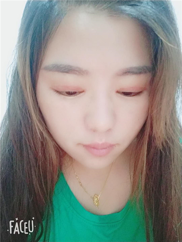 北京圣嘉新陈圣英双眼皮怎么样?价格案例