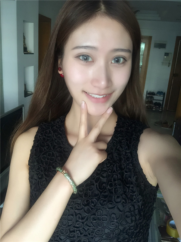 随州奥莱双眼皮怎么样?价格案例