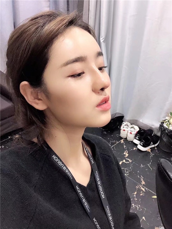 厦门安黛美林清福脂肪填充怎么样?价格案例
