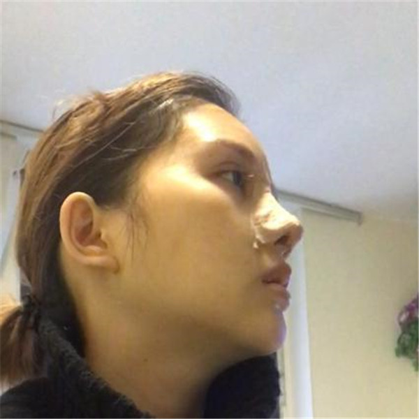 南京克拉美黄小东鼻部手术怎么样?价格案例