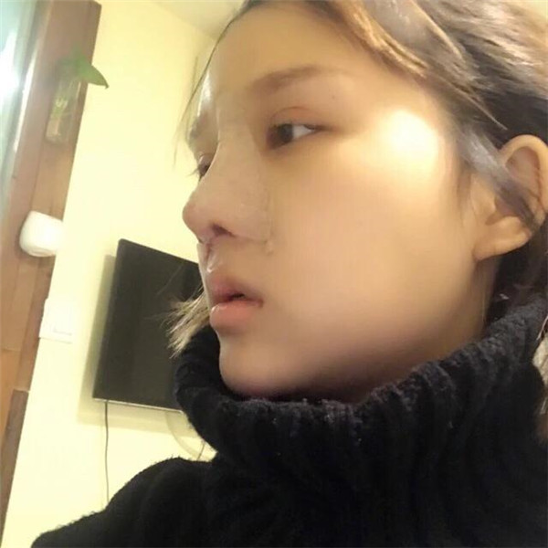 南京克拉美黄小东鼻部手术怎么样?价格案例