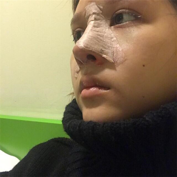 南京克拉美黄小东鼻部手术怎么样?价格案例