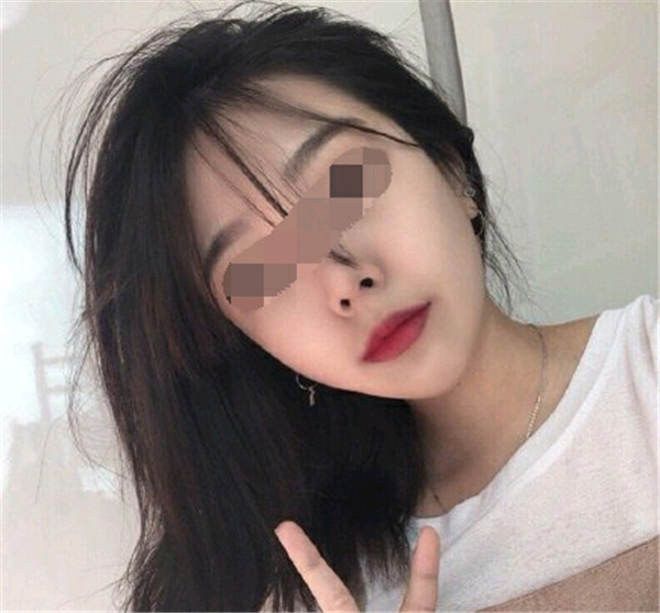 武汉中翰吴中兴颧骨内推怎么样?价格案例