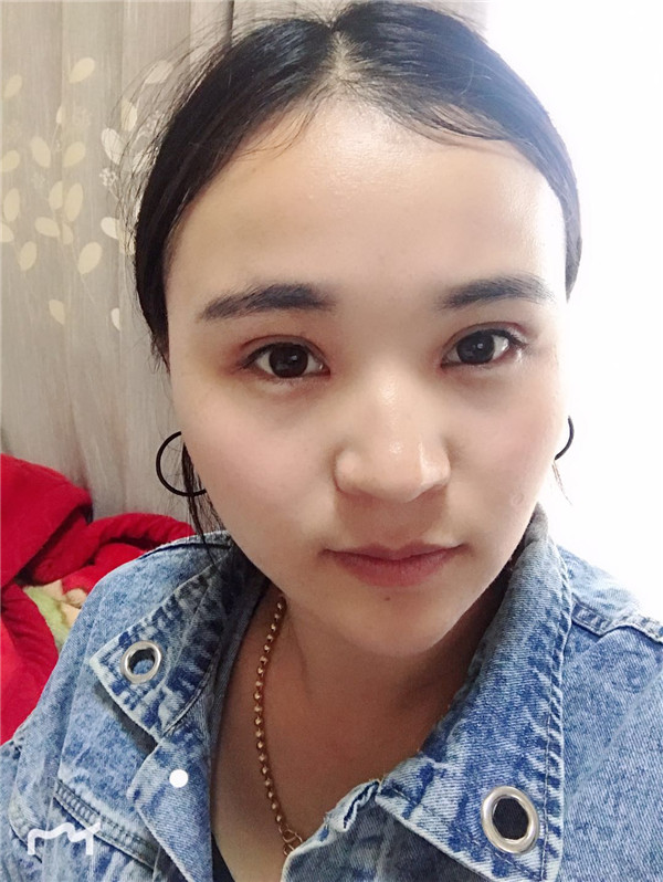 云南华美美莱李韬眼部综合怎么样?价格案例