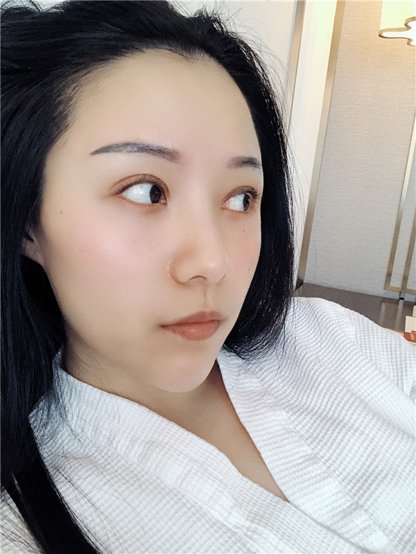 杭州艺星杨连华眼部整形怎么样?价格案例