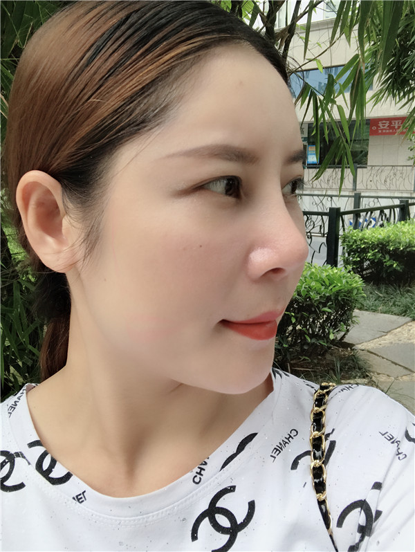 福州格莱美周秀峰脂肪填充怎么样?价格案例