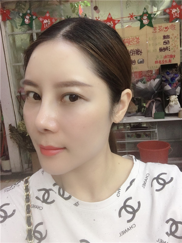 福州格莱美周秀峰脂肪填充怎么样?价格案例