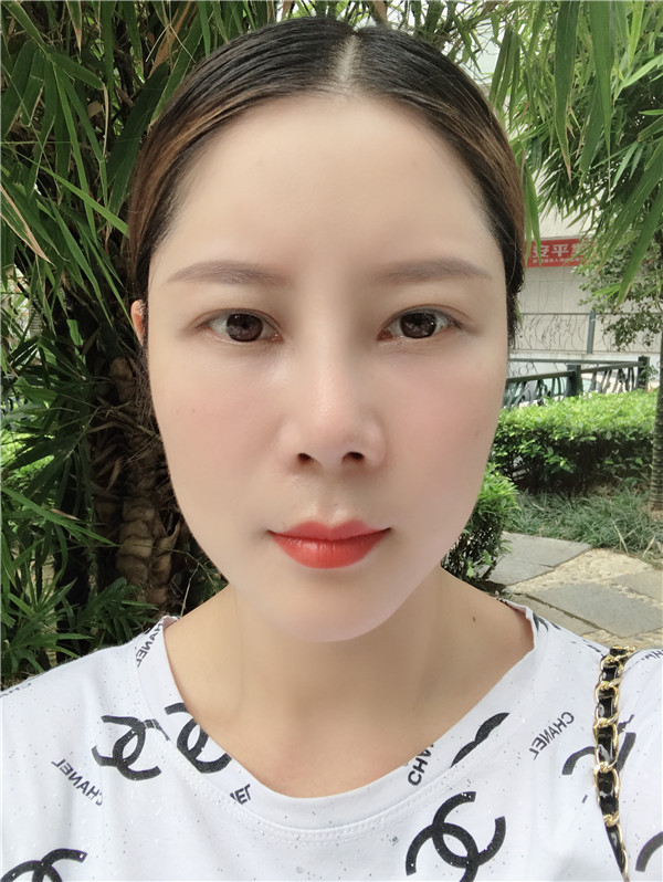福州格莱美周秀峰脂肪填充怎么样?价格案例