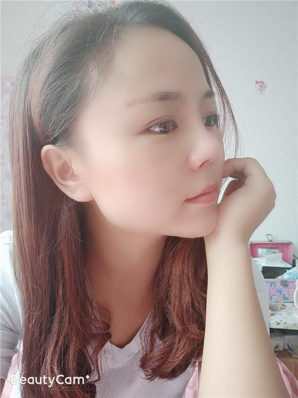 云南华美美莱洪晓娅隆鼻怎么样?价格案例