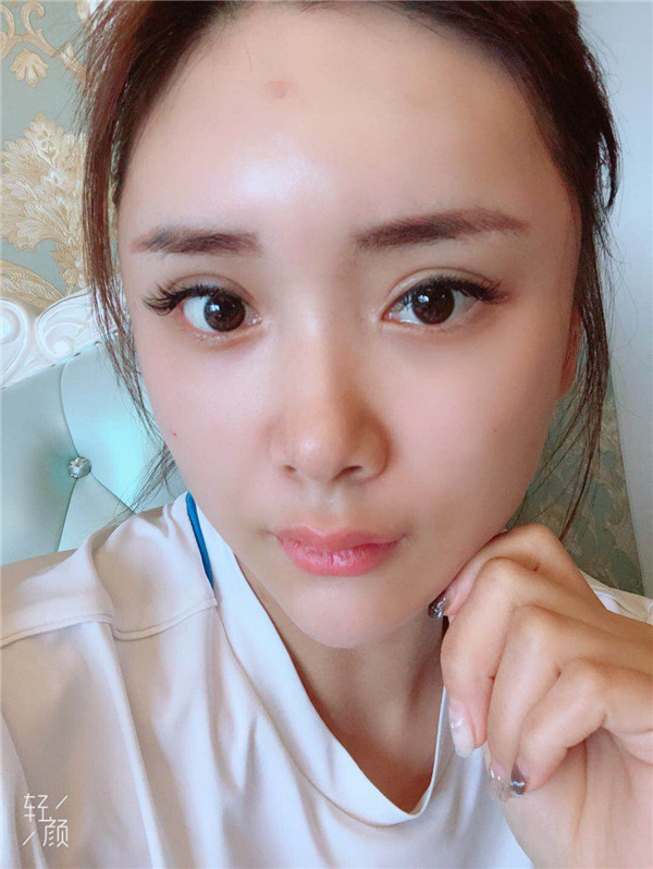 杭州维多利亚马腾脂肪填充怎么样?价格案例