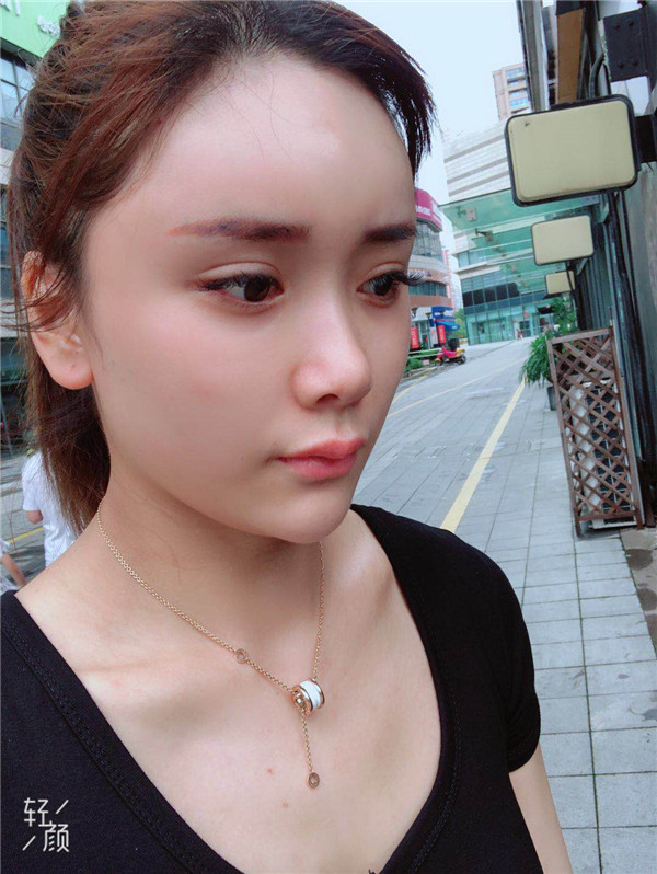 杭州维多利亚马腾脂肪填充怎么样?价格案例
