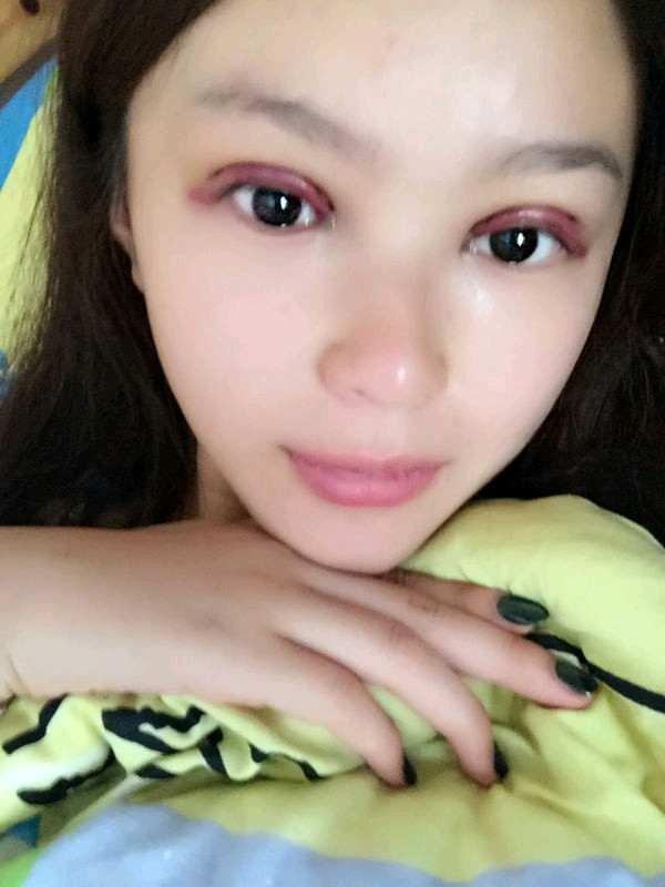 苏州紫馨眼双眼皮怎么样?价格案例
