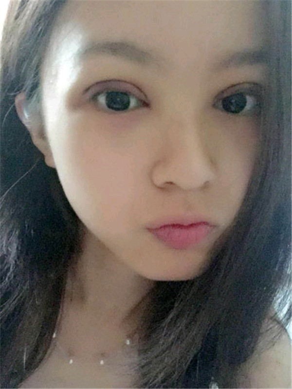 苏州紫馨眼双眼皮怎么样?价格案例