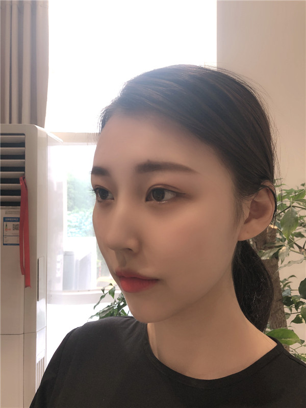 南京美贝尔陈刚隆鼻怎么样?价格案例