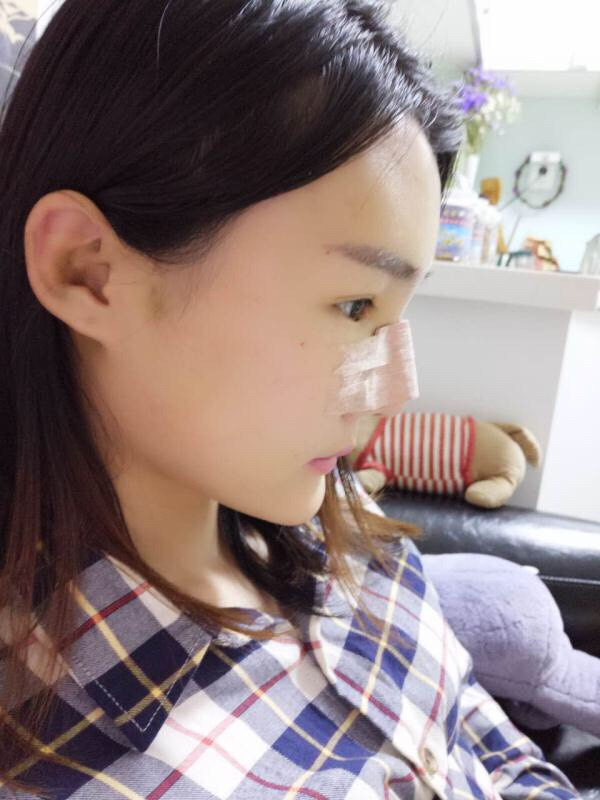 厦门安黛美林清福做鼻子怎么样?价格案例