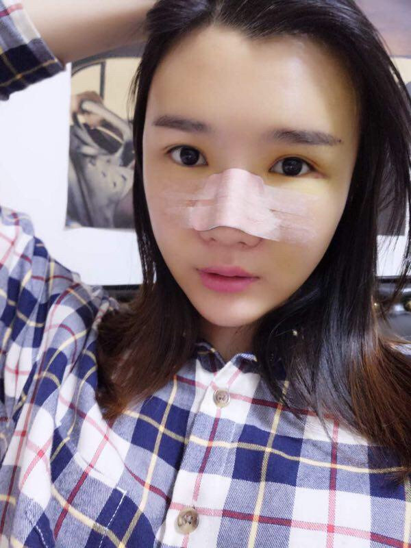 厦门安黛美林清福做鼻子怎么样?价格案例