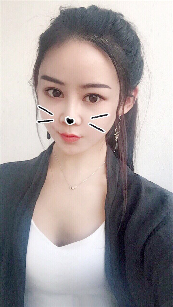 杭州时光陈小平下颌角磨骨怎么样?价格案例