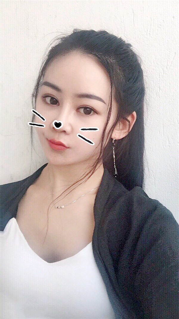 杭州时光陈小平下颌角磨骨怎么样?价格案例