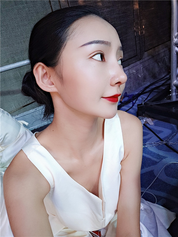 云南华美美莱李韬双眼皮怎么样?价格案例