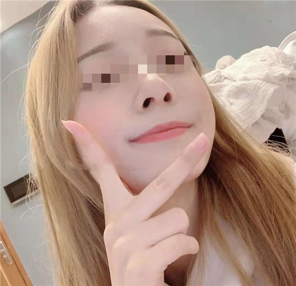 郑州辰星王保健鼻部手术怎么样?价格案例