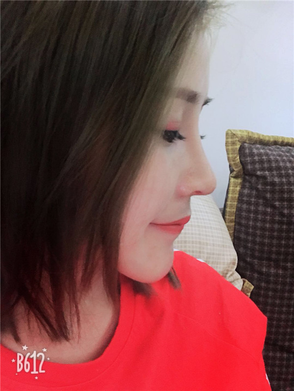 武汉美立方胡江伟体软骨垫鼻尖怎么样?价格案