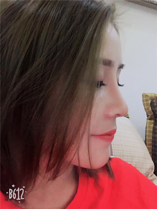 武汉美立方胡江伟体软骨垫鼻尖怎么样?价格案
