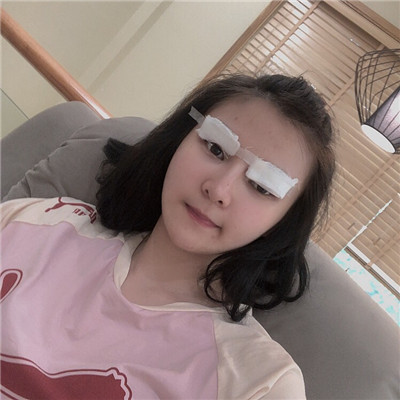 绍兴越城歆菲双眼皮好不好?果怎么样?案例分享
