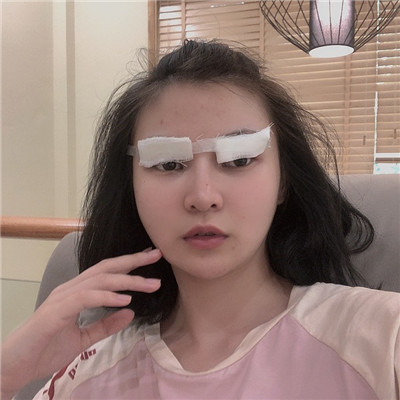 绍兴越城歆菲双眼皮好不好?果怎么样?案例分享