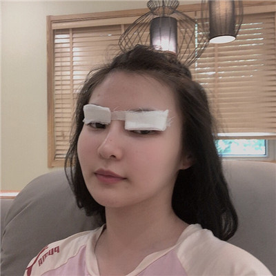 绍兴越城歆菲双眼皮好不好?果怎么样?案例分享