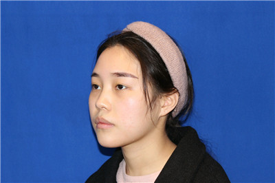 福州格莱美鼻部手术怎么样?案例分享