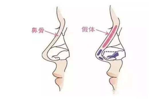 隆鼻恢复期要多久?痛不痛?