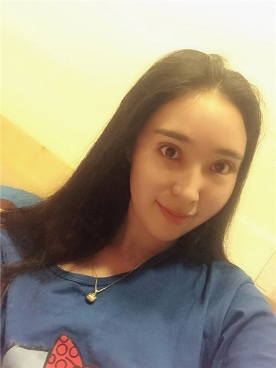 烟台华怡聂瑞锋双眼皮好不好?案例分享