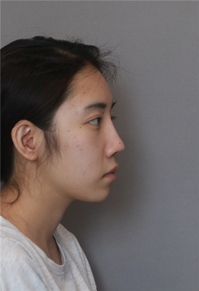 北京米扬丽格夏正义鼻部手术怎么样?案例分享