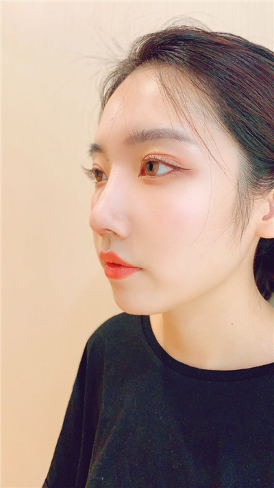 北京米扬丽格夏正义鼻部手术怎么样?案例分享