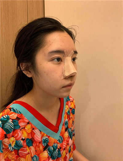 北京米扬丽格夏正义鼻部手术怎么样?案例分享