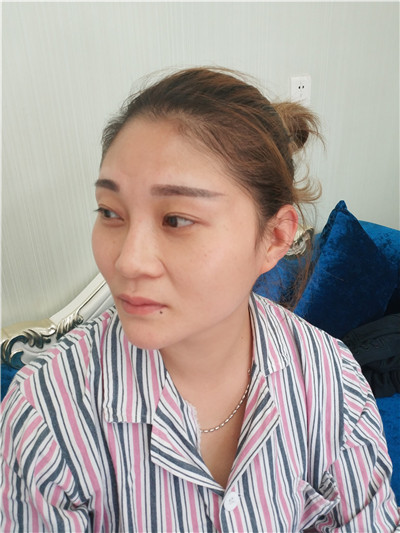 武汉新至美聂祝锋鼻部手术怎么样?好不好?案例分享