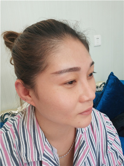 武汉新至美聂祝锋鼻部手术怎么样?好不好?案例分享