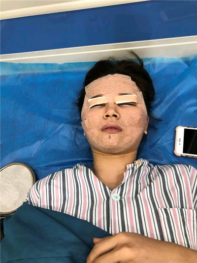 深圳兰乔陈邦胤切开双眼皮怎么样?好不好?案例分享