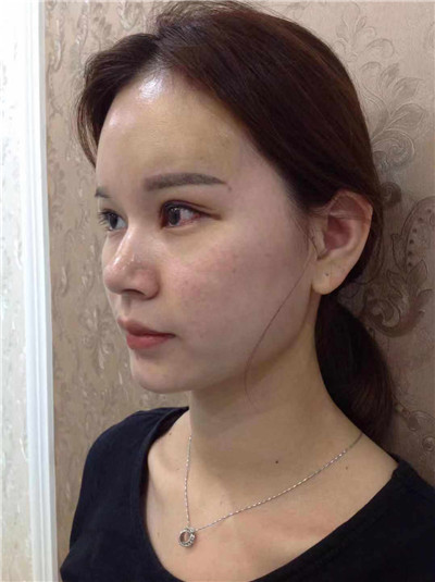 深圳兰乔陈邦胤切开双眼皮怎么样?好不好?案例分享